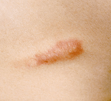Keloids