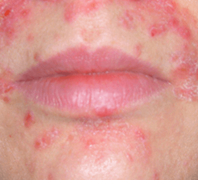 Perioral Dermatitis
