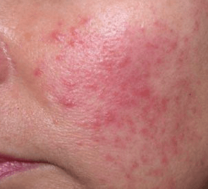 Rosacea