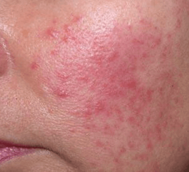 Rosacea