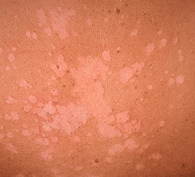 Tinea Versicolor