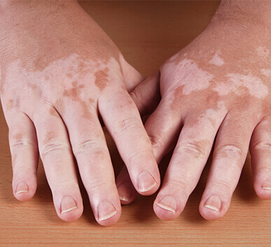 Vitiligo