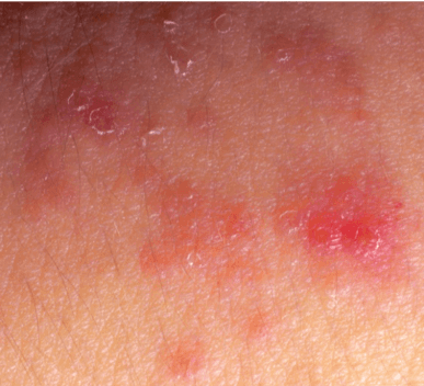 Eczema