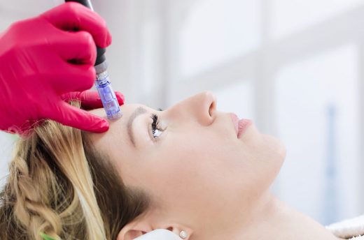 Microneedling