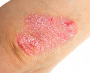 Psoriasis