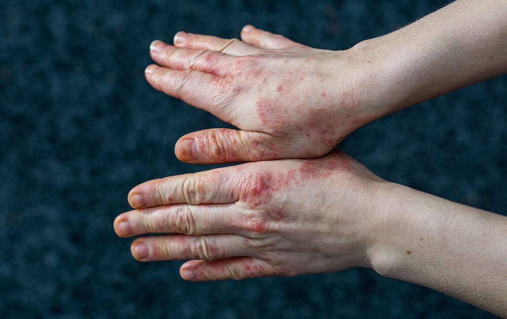 Skin Eruptions and Lesions