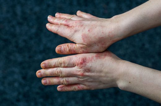 Skin Eruptions and Lesions