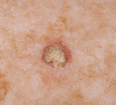 Actinic Keratosis