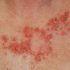 Basal Cell Carcinoma