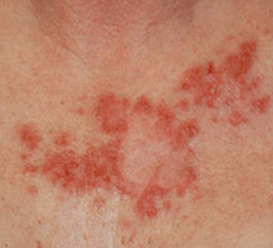 Basal Cell Carcinoma