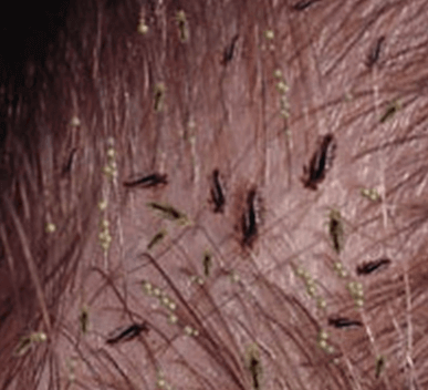 Head Lice