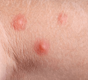 Hives