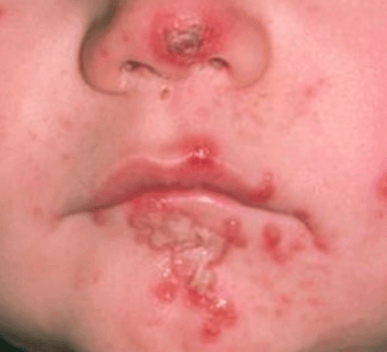 Impetigo
