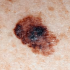 Melanoma