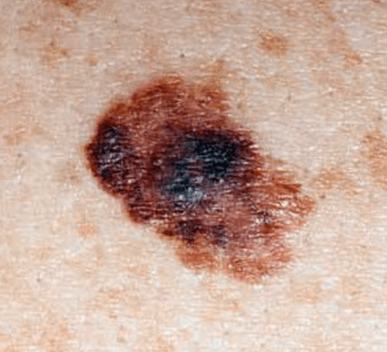 Melanoma