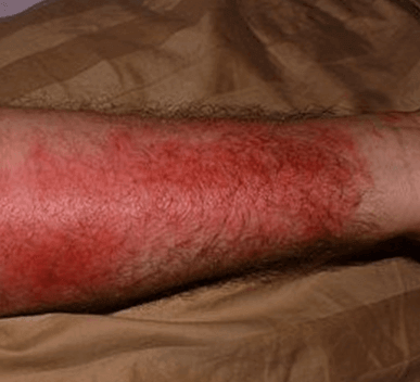 Poison Ivy, Oak and Sumac