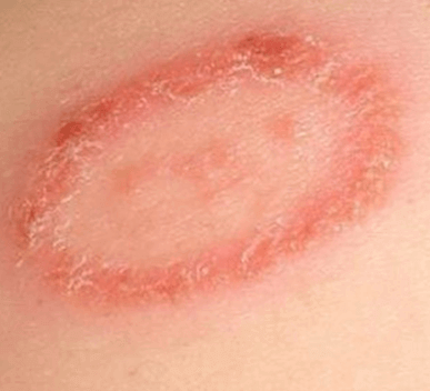 Ringworm