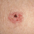 Squamous Cell Carcinoma