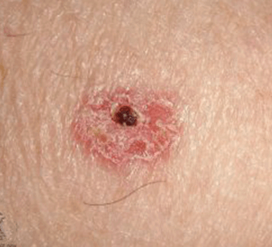 Squamous Cell Carcinoma