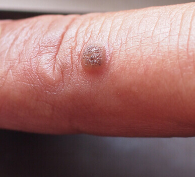 Warts