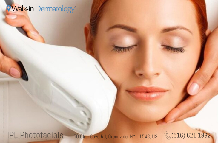 ipl treatment