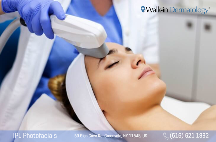 IPL photofacial