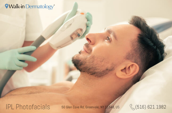IPL treatment male patient