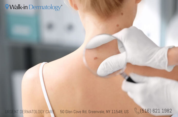 dermatologist checking out patient's mole with magnifying glass