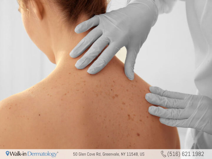 dermatologist checking patient's moles