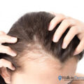Covid-19 and Hair Loss
