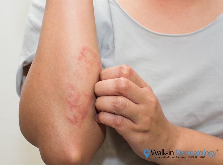 Eczema | Walk-in Dermatology