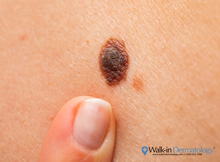 What Happens if you Accidentally Scratch Off a Mole? | Walk-in Dermatology