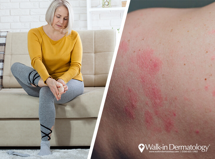 Lingering Covid Skin Conditions