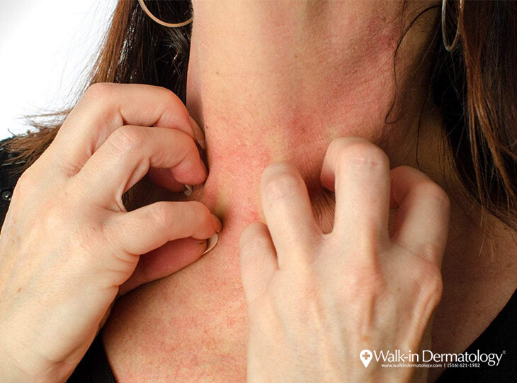 What you Should Know about Silver and Nickel Allergies