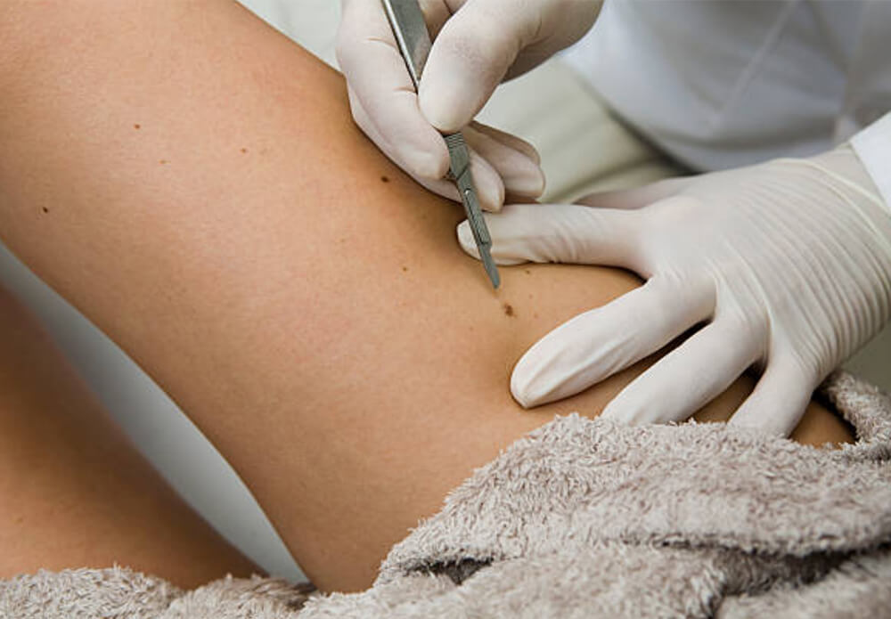 Skin Cancer Excision Surgeries | Walk-in Dermatology