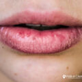 Chapped Lips