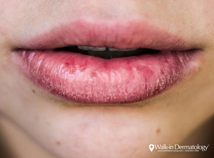 Chapped Lips