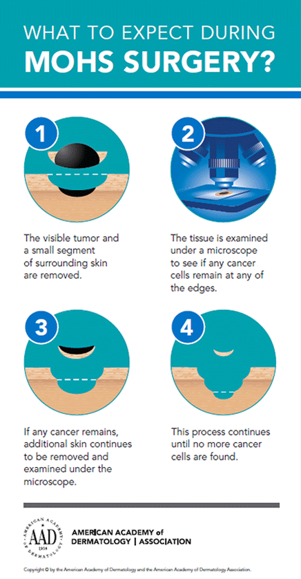 Mohs Surgery Procedure