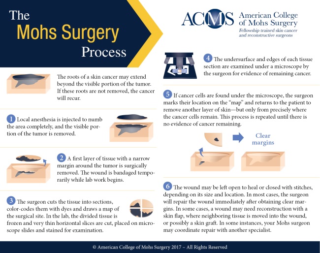 The Mohs Surgery Process - ACMS