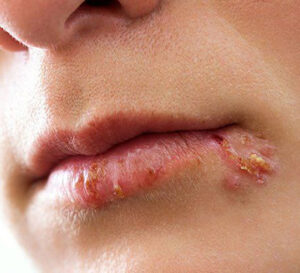 cold sore on lip
