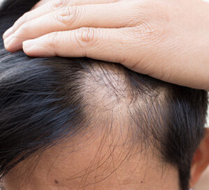 hair loss