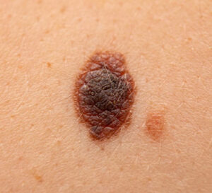 skin cancer mole
