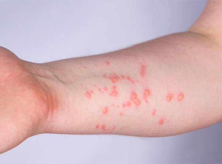 Monkey Pox on someone's arm