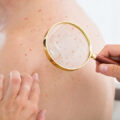 Dermatologist doing full body skin exam with magnifying glass on a man