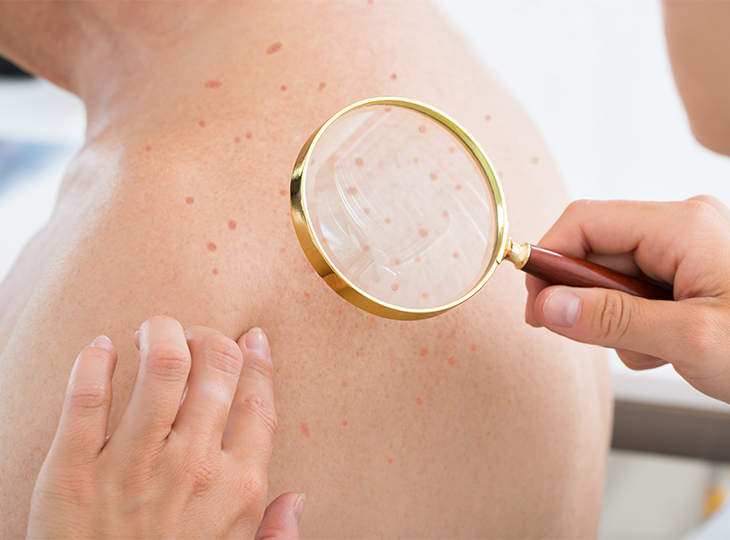 Dermatologist doing full body skin exam with magnifying glass on a man