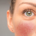 Close-up of a woman with Rosacea on her cheeks